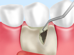 ［重度歯周炎の治療法］フラップ手術