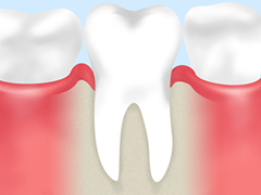【虫歯予防には歯の再石灰化がカギです】