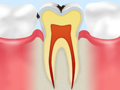 C1（エナメル質の虫歯）