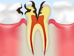 C3（神経まで達した虫歯）