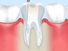 根管治療とは？