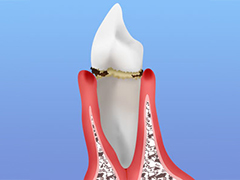 軽度歯周炎