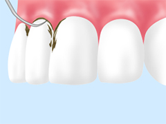 ［軽度歯周炎の治療法］スケーリング
