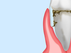 ［中等度歯周炎の治療法］ルートプレーニング