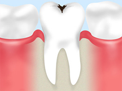 【虫歯予防には歯の再石灰化がカギです】